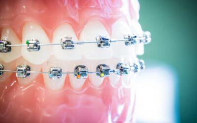 ¿Qué no debes hacer con los brackets recién puestos?