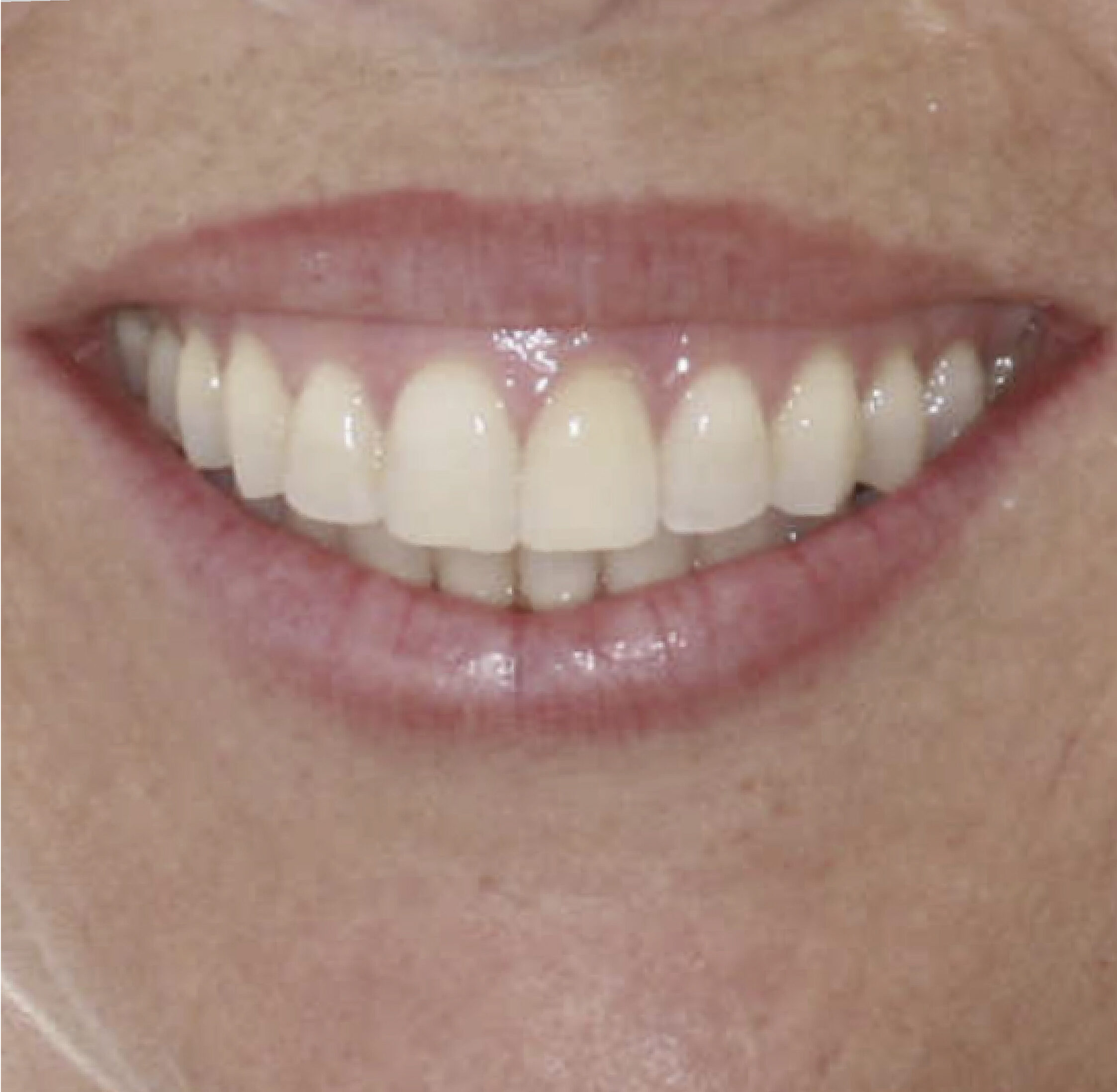 ortodoncia invisible malaga