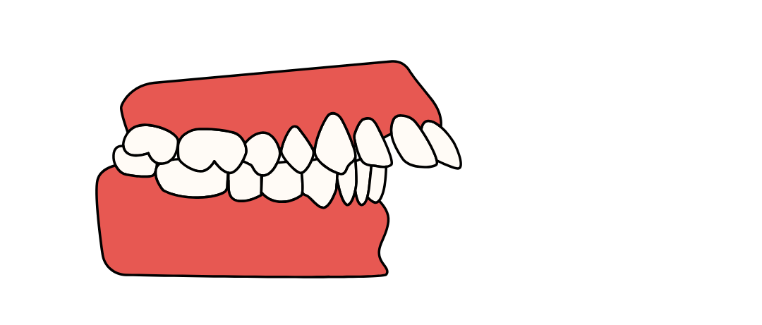maloclusión dental 