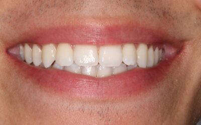 Blanqueamiento dental en casa con férulas