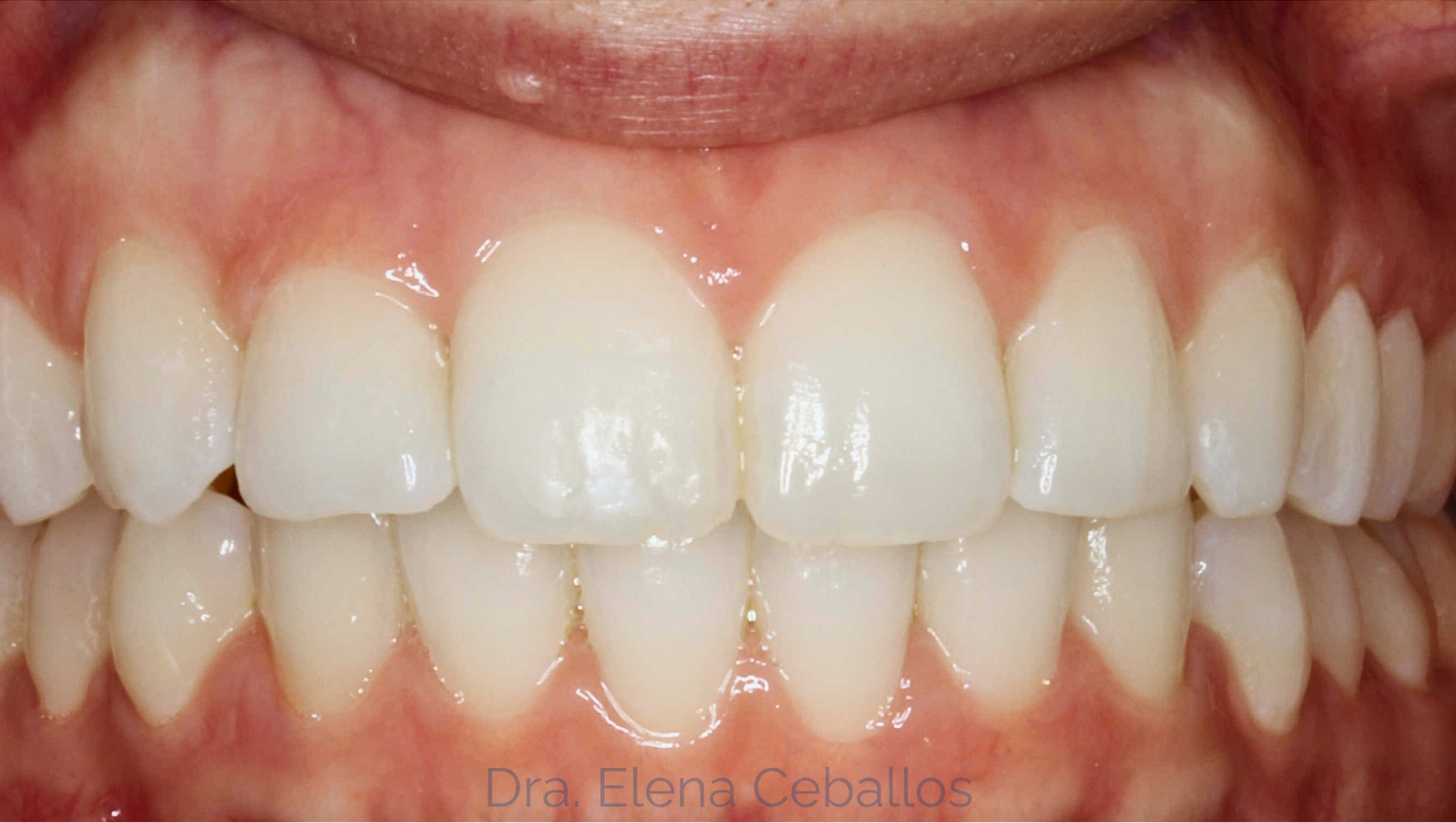 blanqueamiento dental malaga antes