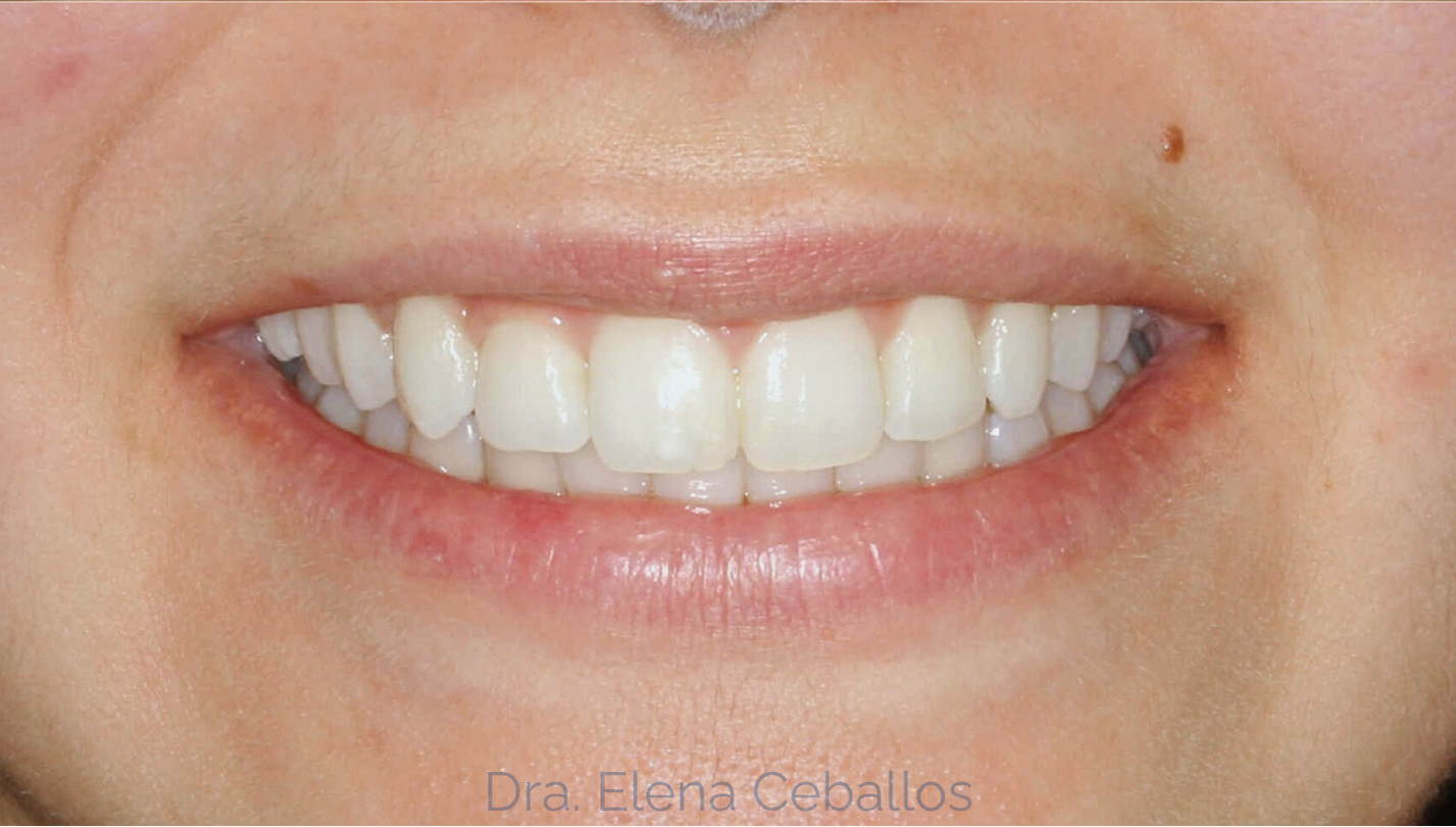 blanqueamiento dental antes malaga