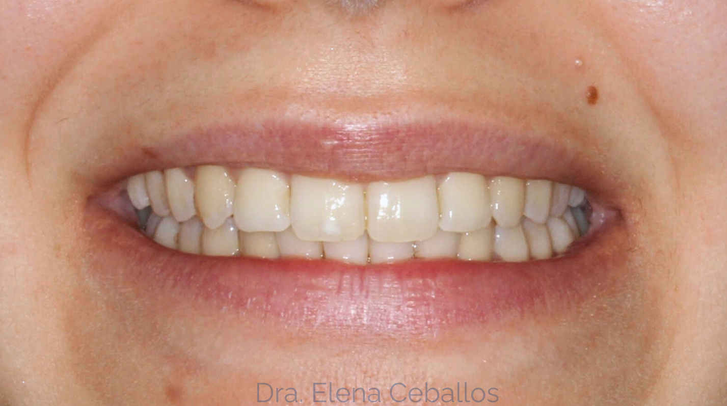 BLANQUEAMIENTO 2 despues de tratamiento full blanqueamiento dental antes malaga