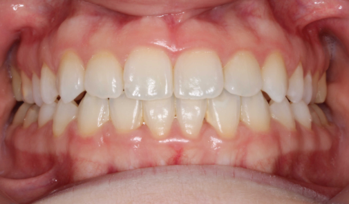blanqueamiento dental en Málaga